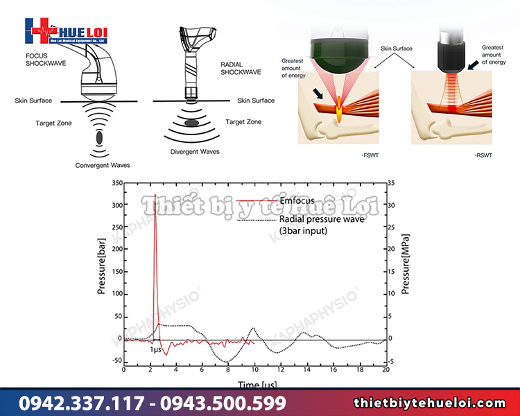so sánh tác dụng của máy xung kích EMFOCUS-III