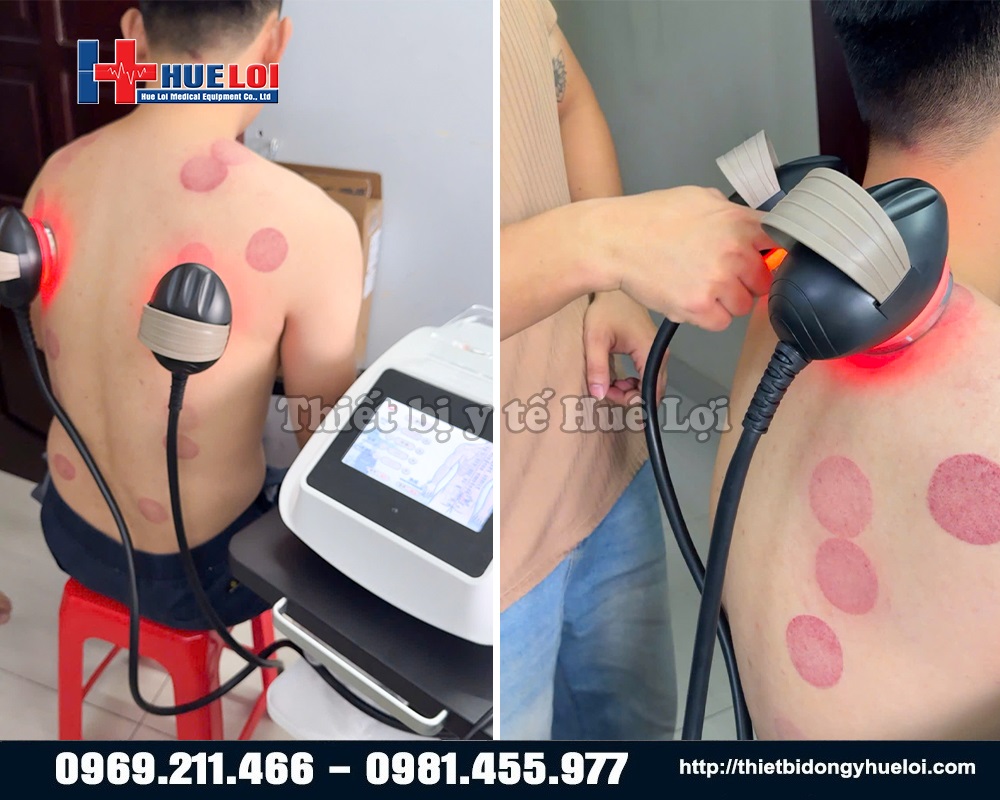 máy dds có giác hơi nhiệt và điện